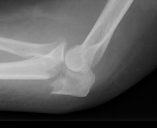 Olecranon Fracture Lateral